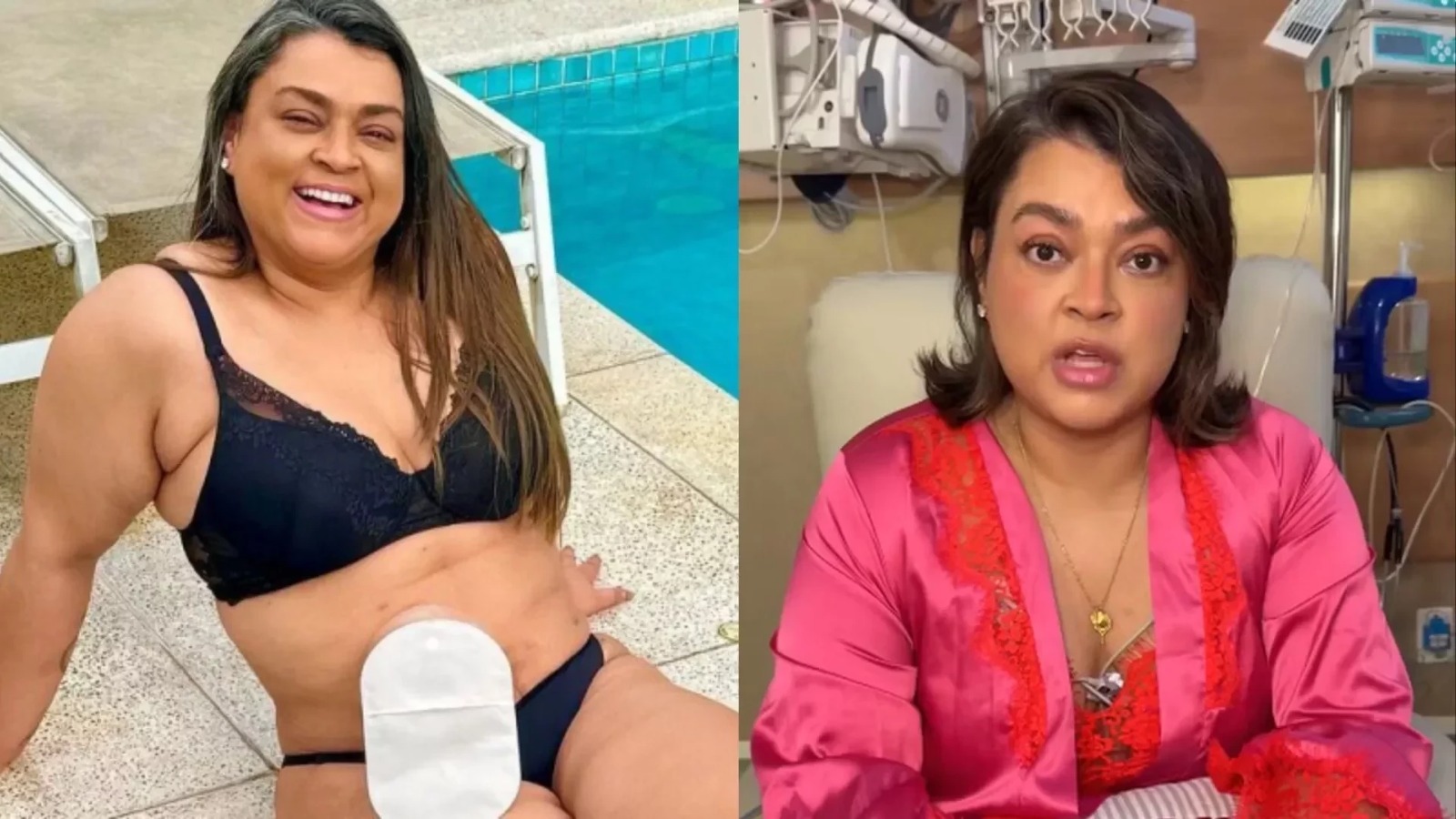 Preta Gil revela que colocou bolsa de colostomia definitiva: “Um desafio muito maior”