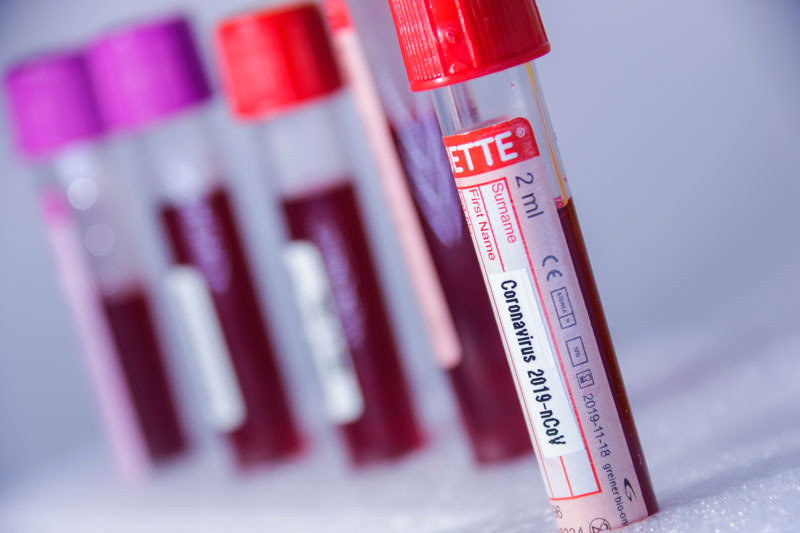 Centros de pesquisa do país vão estudar transfusão de plasma do sangue contra a Covid -19